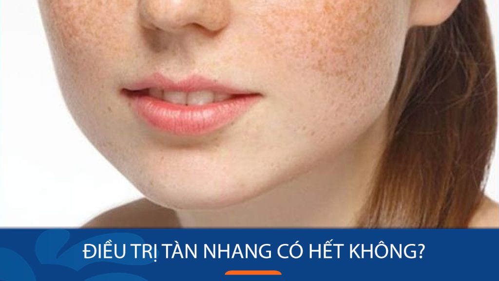 Điều trị tàn nhang có hết không? 3 Giải pháp điều trị tại Kangnam