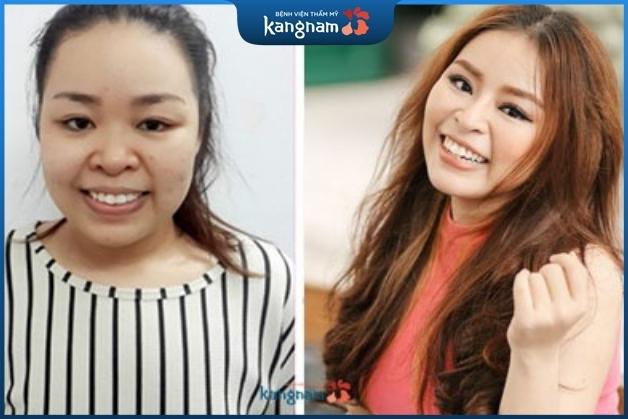 Tương tự Kim Anh, Bảo Trâm cũng hoàn toàn lột xác sau nâng mũi