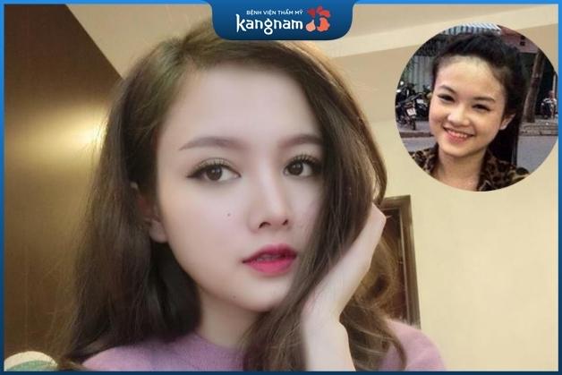 Hot Girl Trang Mễ chia sẻ ngay sau khi nâng mũi tại Kangnam