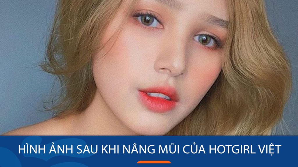Choáng trước những hình ảnh sau khi nâng mũi của hotgirl việt