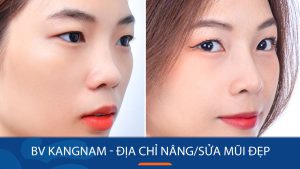 BV KangNam – Địa chỉ nâng/sửa mũi đẹp, Uy tín, An toàn