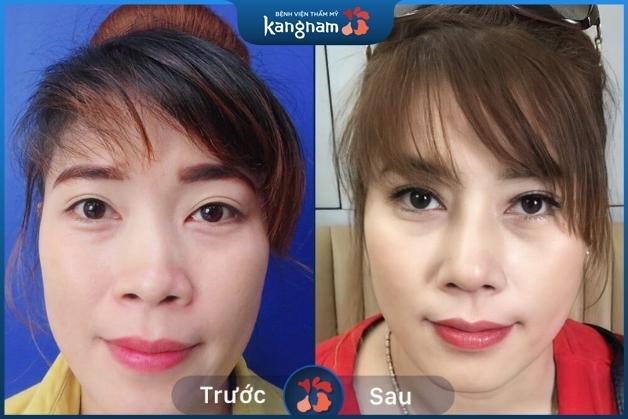 Mũi trước đó của khách hàng bị lệch