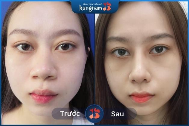 Hình ảnh trước và sau thu nhỏ đầu mũi của khách hàng tại Kangnam