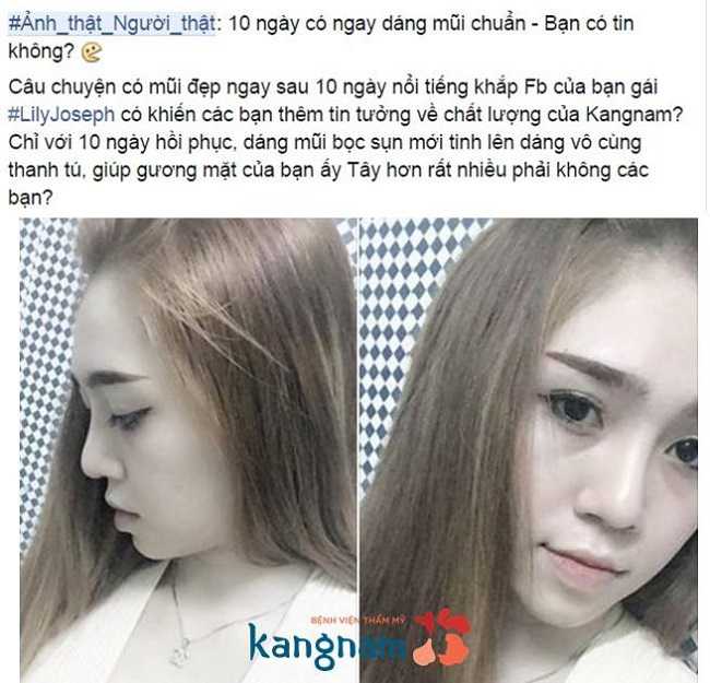 Câu chuyện nâng mũi của một khách Việt Kiều được chia sẻ trên mạng xã hội