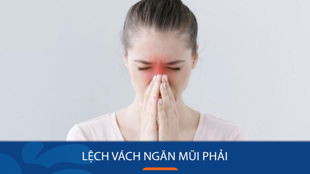 Lệch vách ngăn mũi phải: Nguyên nhân, Cách trị và Phòng ngừa