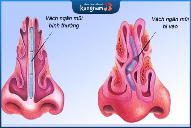 Lệch vách ngăn mũi phải