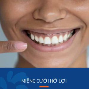 Miệng cười hở lợi là gì? Kangnam điều trị cười hở lợi hiệu quả