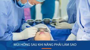 Mũi hỏng sau khi nâng phải làm sao khắc phục: Bác sĩ kangnam giải đáp