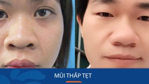Mũi thấp tẹt – Chỉ định của chuyên gia về cách khắc phục mũi tẹt