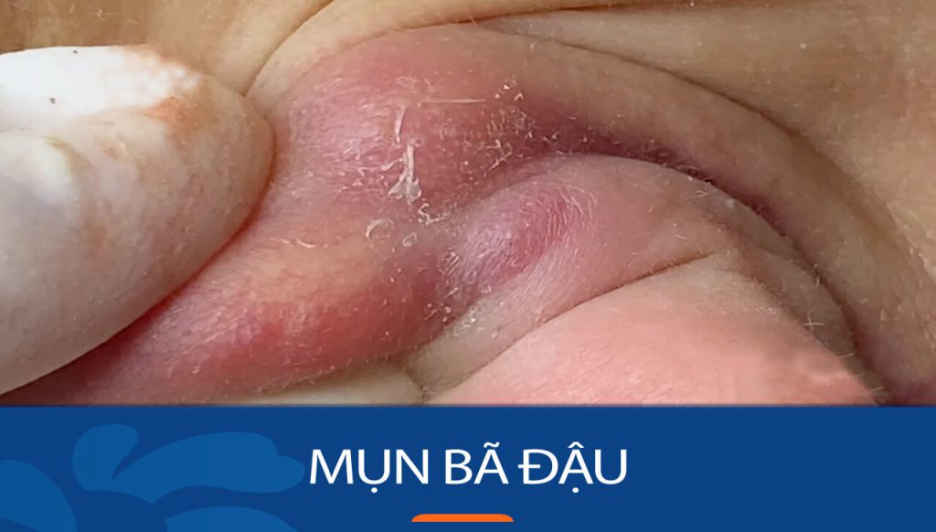 Mụn bã đậu: Nguyên nhân, triệu chứng và cách điều trị hiệu quả