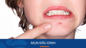 Mụn đầu đen: 6 Bí quyết Vàng để Loại bỏ Hoàn toàn