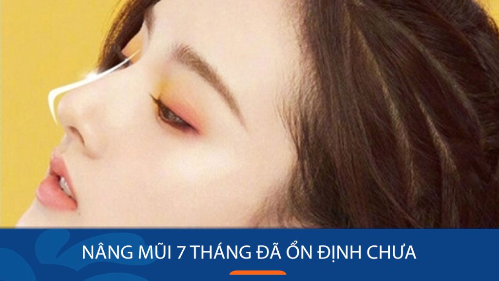 Nâng mũi 7 tháng đã ổn định chưa? Bác sĩ Kangnam lý giải