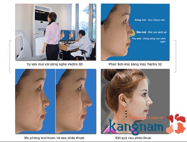 Xem trước dáng mũi qua phần mềm 3D chuẩn xác 99%