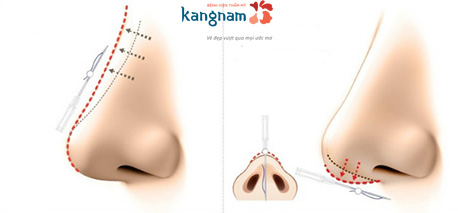 Sử dụng chỉ tự tiêu nâng mũi nên chỉ sau một thời gian mũi sẽ về trạng thái ban đầu