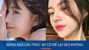 Nâng mũi cấu trúc có để lại sẹo? Giải đáp thắc mắc từ chuyên gia