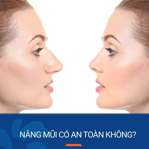 Nâng mũi có an toàn không? Giải đáp thắc mắc từ chuyên gia