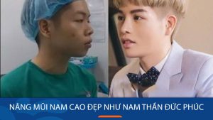 Nâng mũi nam cao đẹp như nam thần đức phúc tại BV KangNam