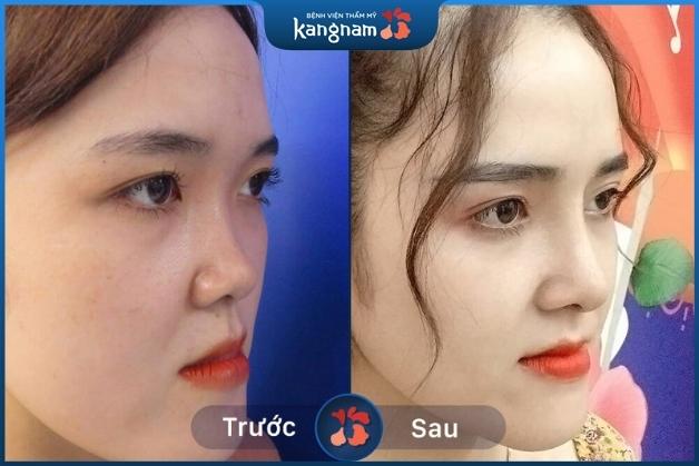 Bạn còn nhận ra họ sau nâng mũi bán cấu trúc tại Kangnam?