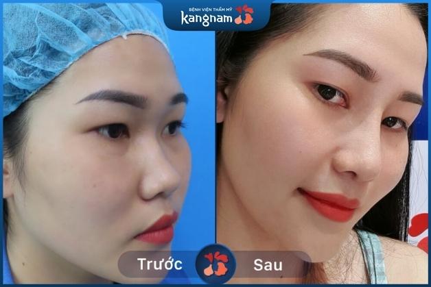 Mũi đẹp tự nhiên của Kim Quy sau nâng mũi không phẫu thuật