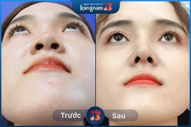 Trước và sau nâng mũi không phẫu thuật tại Kangnam