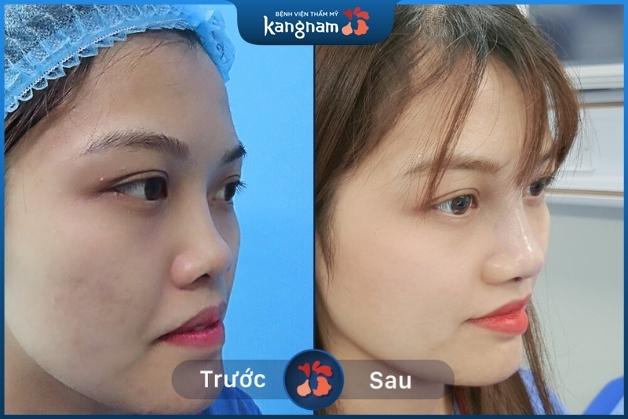 Rất nhiều khách hàng đã thành công nâng mũi không phẫu thuật tại Kangnam