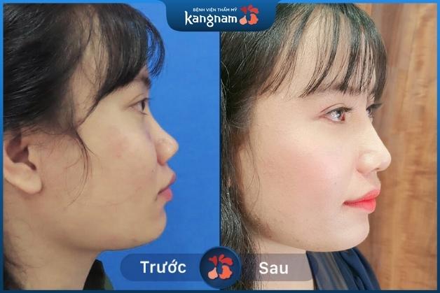 Dáng mũi cao hoàn hảo của khách hàng sau nâng mũi