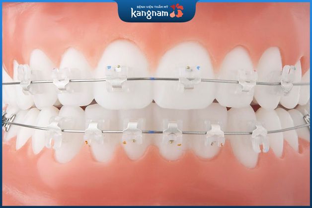 Niềng răng sứ thường khác gì niềng răng tự động?