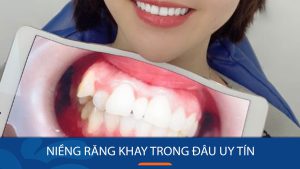 Niềng răng khay trong đâu uy tín hàng đầu tại Hà Nội và HCM