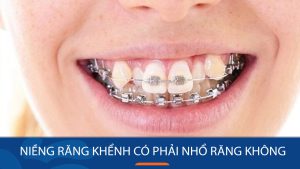 Niềng răng khểnh có phải nhổ răng không? Giải đáp từ Kangnam