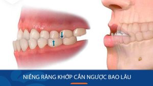 Niềng răng khớp cắn ngược bao lâu hiệu quả?