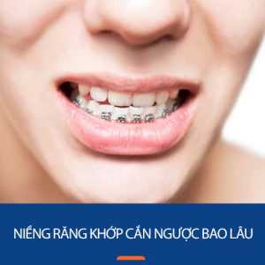 Niềng răng khớp cắn ngược bao lâu hiệu quả? 5 Yếu tố tác động