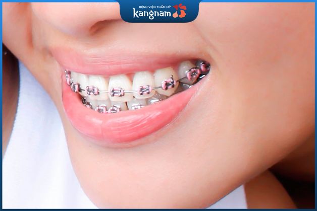 Niềng răng bằng mắc cài kim loại thường là phương pháp chỉnh nha
