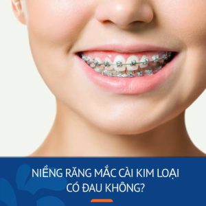 Niềng răng mắc cài kim loại có đau không? Mẹo giảm đau