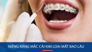 Niềng răng mắc cài kim loại mất bao lâu? Cách rút ngắn thời gian
