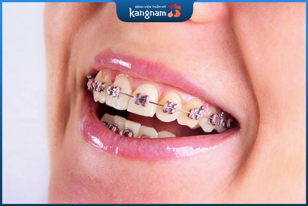 Niềng răng mắc cài kim loại thường mất bao lâu?