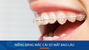 Niềng răng mắc cài sứ mất bao lâu? Các giai đoạn quan trọng