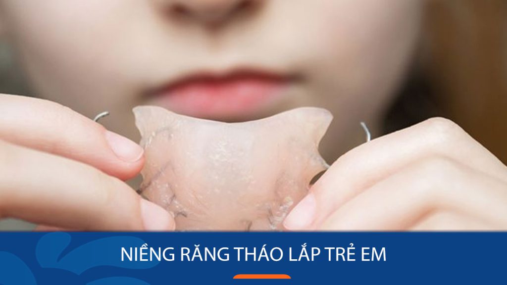 Niềng răng tháo lắp trẻ em có những loại nào?