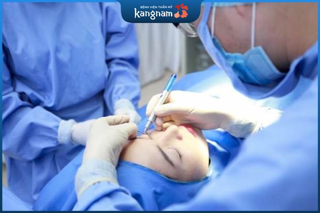 Quy trình phẫu thuật sụp mí ở Kangnam