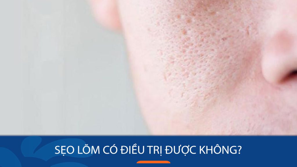 Sẹo lõm có điều trị được không? Loại bỏ hoàn toàn hay chỉ cải thiện? Giải đáp từ chuyên gia!