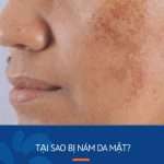 Tại sao bị nám da mặt? 8 Nguyên nhân gây nám và  4 cách phòng ngừa