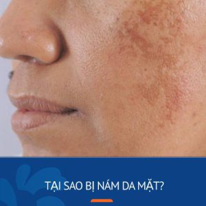 Tại sao bị nám da mặt? 8 Nguyên nhân gây nám và  4 cách phòng ngừa