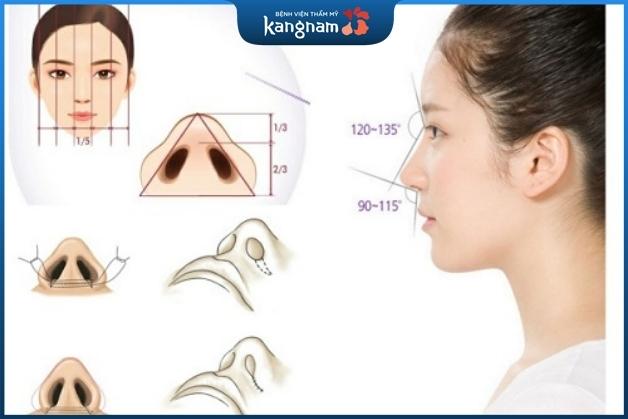 Nâng mũi S-line sụn sườn sử dụng phần sụn tự thân được lấy từ sụn sườn