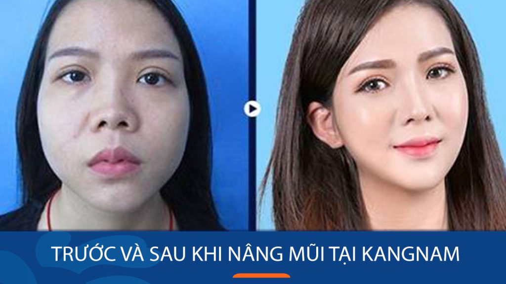 Nâng mũi Kangnam: Lột xác nhan sắc với hình ảnh trước và sau ấn tượng