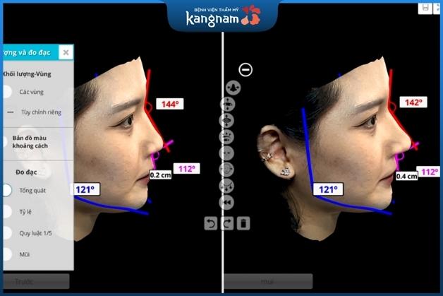 Khách hàng có thể xem trước kết quả và an tâm chỉnh mũi tại Kangnam