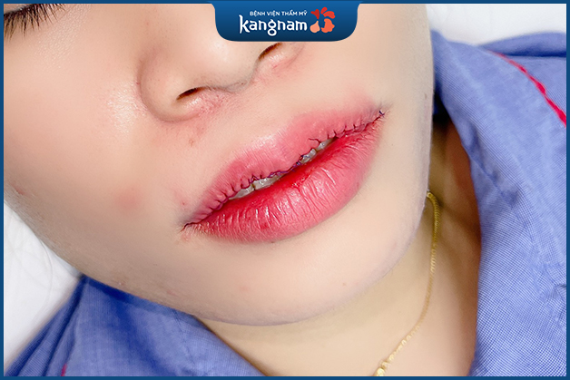 Đôi môi sau Tạo môi tim 6D được chăm sóc để hạn chế sưng đau và viêm nhiễm