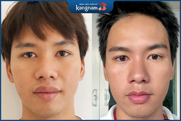 Anh Lê Văn Thành - 31 tuổi, Thu mỏng 6D sau 2 tháng