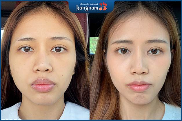 Chị Trần Thị Bích Ngọc - Hải Phòng, 26 tuổi, Thu mỏng môi 6D sau 1,5 tháng