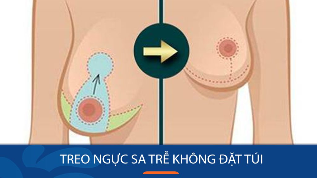 Treo ngực sa trễ không đặt túi: Giải pháp an toàn, tự nhiên cho vòng 1