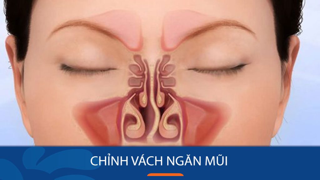 Chỉnh vách ngăn mũi là gì? 3 lưu ý khi phẫu thuật vách ngăn mũi