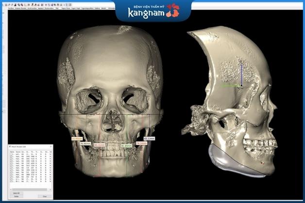 Chup CT mô phỏng sọ của khách hàng theo tỷ lệ 1:1